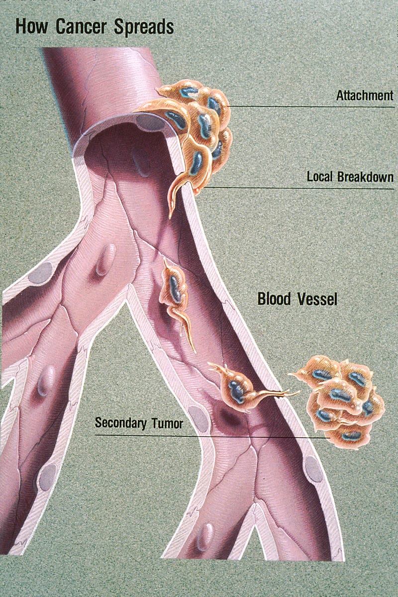 Applications of medical engineering to diagnose and treat metastatic cancers