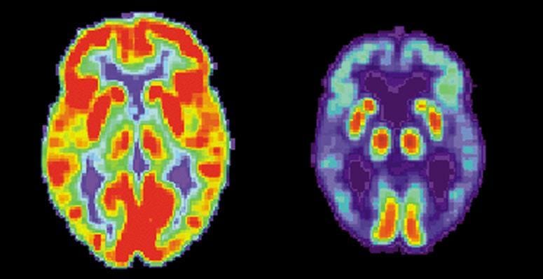 Breakthrough towards curing Alzheimer’s...
