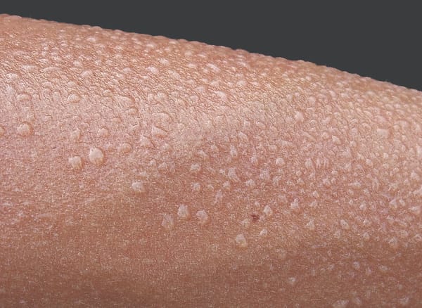 Sweat analysis – a new direction for wearables