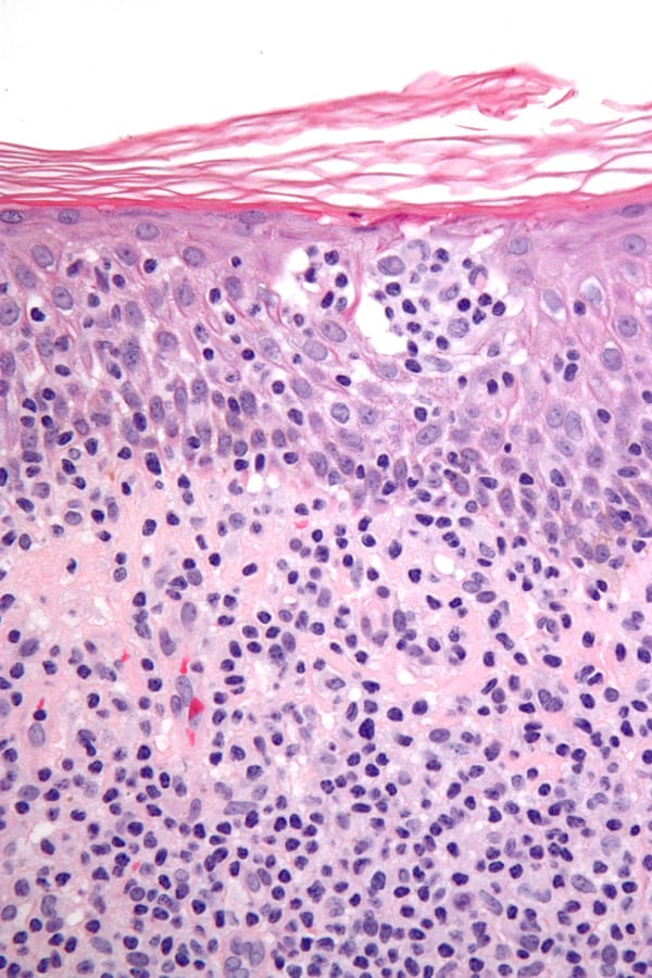Getting under the skin: a new hope for cancer treatment